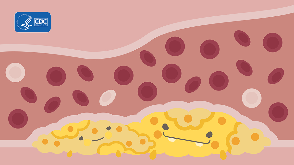 Two cholesterol monsters.